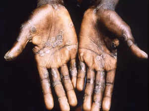 Sweden reports first case of co<em></em>ntagious mpox strain outside Africa